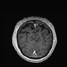 Cerebral arteriovenous malformation (Radiopaedia 84015-99245 Coronal T1 C+ 147).jpg