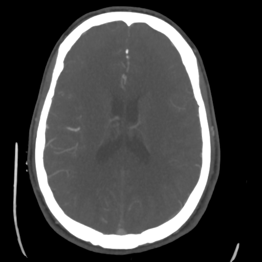 Cerebral arteriovenous malformation (Spetzler-Martin grade 2) (Radiopaedia 41262-44076 E 33).png
