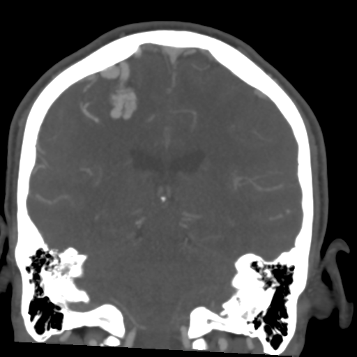Cerebral arteriovenous malformation (Spetzler-Martin grade 2) (Radiopaedia 41262-44076 F 40).png