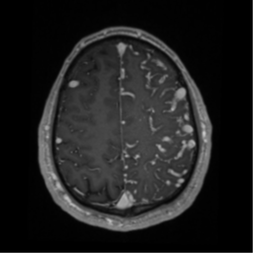 Cerebral arteriovenous malformation - huge (Radiopaedia 35734-37272 Axial T1 C+ 58).png
