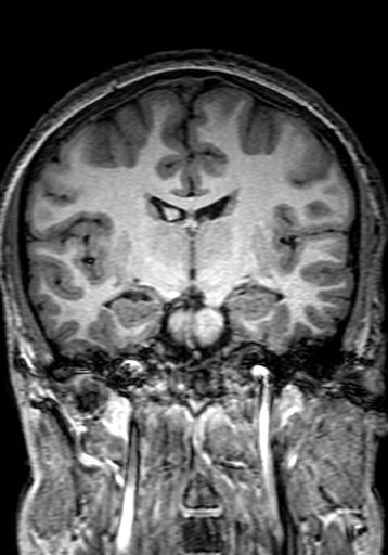 Cerebral arteriovenous malformation at posterior body of corpus callosum (Radiopaedia 74111-84925 Coronal T1 163).jpg