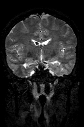 Cerebral arteriovenous malformation at posterior body of corpus callosum (Radiopaedia 74111-84925 Coronal T2 83).jpg