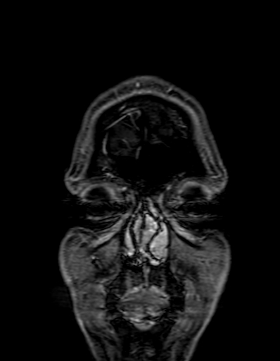 Cerebral arteriovenous malformation at posterior body of corpus callosum (Radiopaedia 74111-84925 K 5).jpg