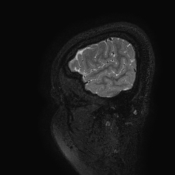 Cerebral arteriovenous malformation at posterior body of corpus callosum (Radiopaedia 74111-84925 Sagittal T2 129).jpg