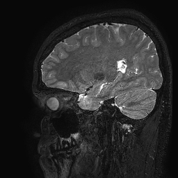 Cerebral arteriovenous malformation at posterior body of corpus callosum (Radiopaedia 74111-84925 Sagittal T2 92).jpg