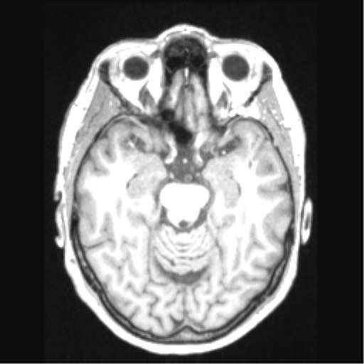Cerebral arteriovenous malformation with hemorrhage (Radiopaedia 34422-35737 Axial T1 30).png