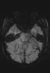 File:Cerebral cavernoma and development venous anomaly (Radiopaedia 37603-39482 Axial SWI MIP 12).png