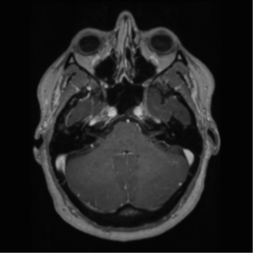 Cerebral cavernoma and development venous anomaly (Radiopaedia 37603-39482 Axial T1 C+ 20).png