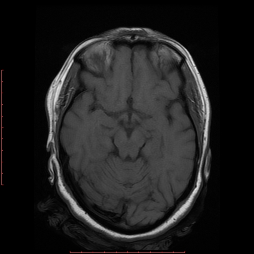 File:Cerebral cavernous malformation (Radiopaedia 26177-26306 Axial T1 9).jpg