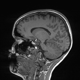 File:Cerebral cavernous venous malformation (Radiopaedia 70008-80021 Sagittal T1 31).jpg