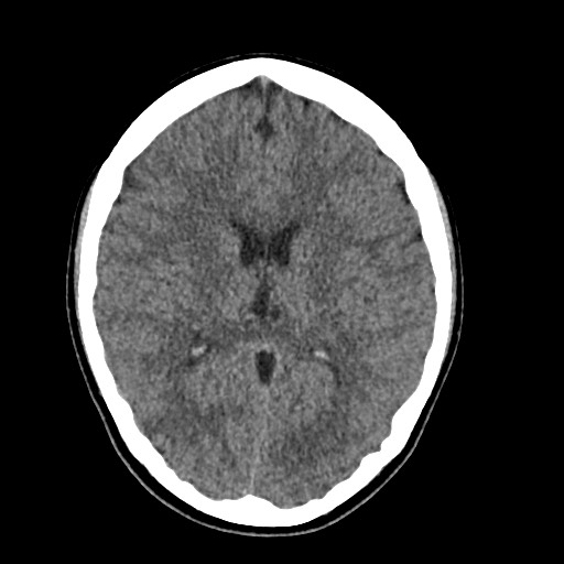 Cerebral cavernous venous malformation (Radiopaedia 70008-80022 Axial non-contrast 29).jpg