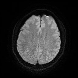 Cerebral cavernous venous malformation (Zabramski type II) (Radiopaedia 85511-101198 Axial DWI 21).jpg
