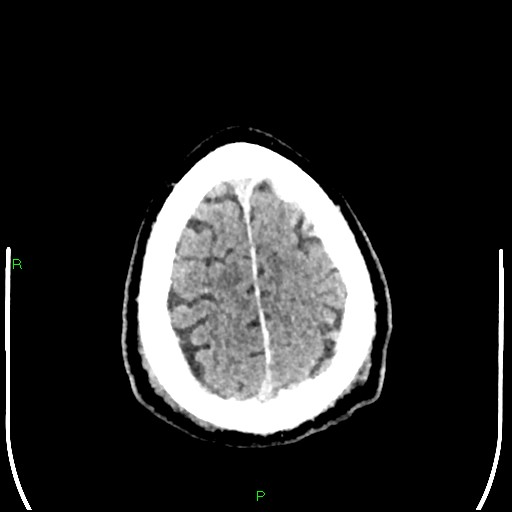 Cerebral contusions (Radiopaedia 33868-35039 Axial non-contrast 193).jpg