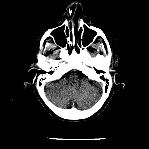 File:Cerebral edema (evolution in time) (Radiopaedia 19418-19441 non-contrast 23).jpg