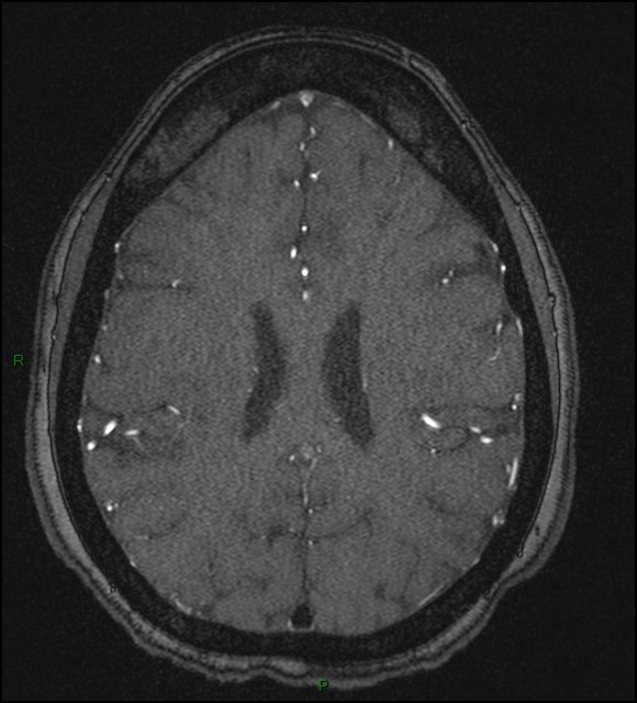 Cerebral fat embolism (Radiopaedia 35022-36525 Axial TOF 136).jpg