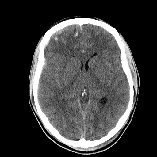 File:Cerebral hemorrhagic contusions- temporal evolution (Radiopaedia 40224-42753 Axial non-contrast 16).png