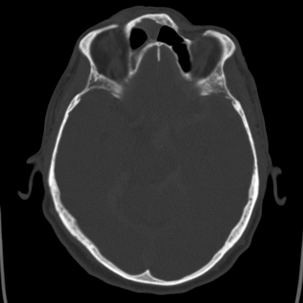Cerebral hemorrhagic contusions (Radiopaedia 23145-23188 Axial bone window 21).jpg