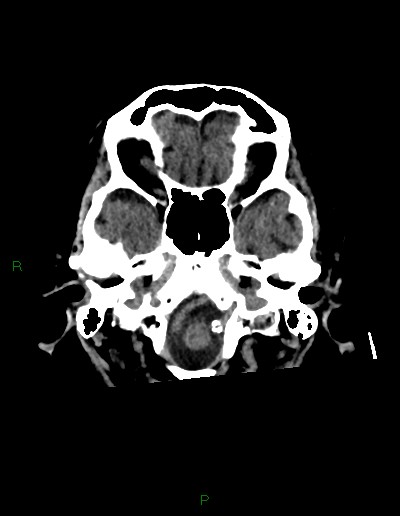 File:Cerebral metastases - ependymal and parenchymal (Radiopaedia 79877-93131 Axial non-contrast 6).jpg