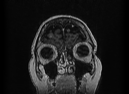 Cerebral metastases from lung cancer with amyloid angiopathy and cerebellopontine angle meningioma (Radiopaedia 74306-85191 Coronal T1 C+ 5).jpg