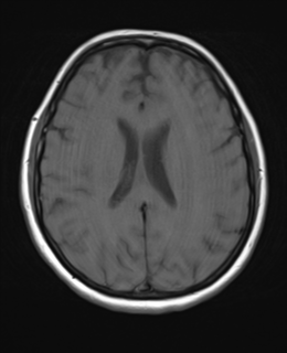 File:Cerebral metastases mimicking abscesses (Radiopaedia 45841-50131 Axial T1 18).png