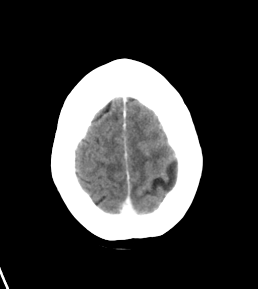 File:Cerebral metastasis (Radiopaedia 46744-51260 Axial C+ delayed 26).png