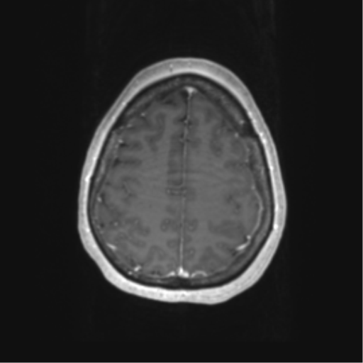 File:Cerebral metastasis mimicking glioblastoma (Radiopaedia 69155-78937 Axial T1 C+ 55).png
