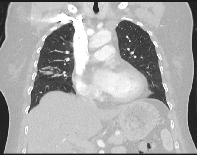 Cerebral metastasis to basal ganglia (Radiopaedia 81568-95414 Coronal lung window 38).png