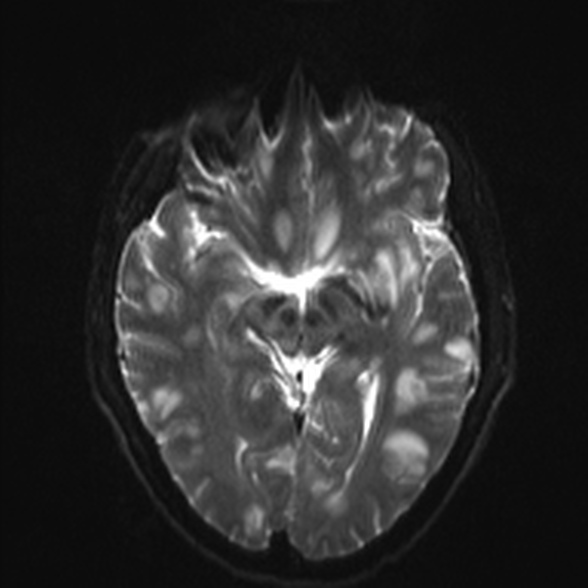 File:Cerebral toxoplasmosis (Radiopaedia 53993-60132 Axial DWI 12).jpg