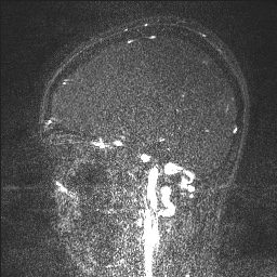 Cerebral tuberculosis with dural sinus invasion (Radiopaedia 60353-68090 Sagittal MRV 101).jpg