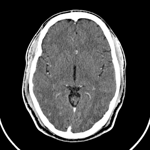 File:Cerebral venous angioma (Radiopaedia 69959-79977 B 40).jpg