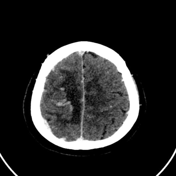 Cerebral venous hemorrhagic infarct from venous sinus thrombosis (Radiopaedia 55433-61883 Axial C+ delayed 30).jpg