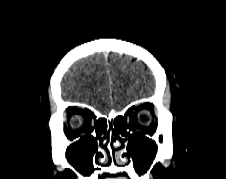 Cerebral venous hemorrhagic infarct from venous sinus thrombosis (Radiopaedia 55433-61883 Coronal C+ delayed 17).jpg