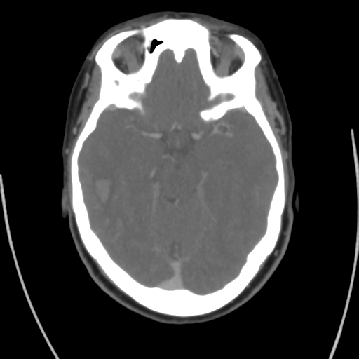 Cerebral venous infarct related to dural venous sinus thromboses (Radiopaedia 35292-36804 Axial C+ delayed 20).png
