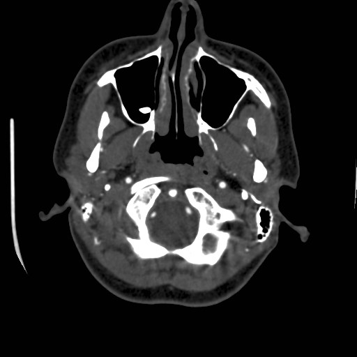 Cerebral venous sinus thrombosis (Radiopaedia 40619-43227 A 20).jpg