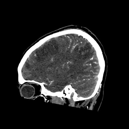 File:Cerebral venous throbmosis - hemorrhagic venous infarction (Radiopaedia 87318-103613 Sagittal CT venogram 11).jpg