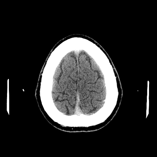 File:Cerebral venous thrombosis (CVT) (Radiopaedia 77524-89685 Axial non-contrast 42).jpg