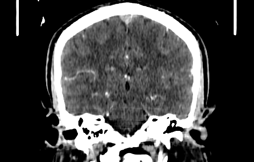 File:Cerebral venous thrombosis (CVT) (Radiopaedia 77524-89685 C 37).jpg