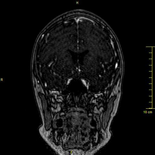 Cerebral venous thrombosis (Radiopaedia 23288-23351 MRV 42).JPG