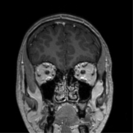 Cerebral venous thrombosis (Radiopaedia 38392-40469 Coronal T1 C+ 73).png