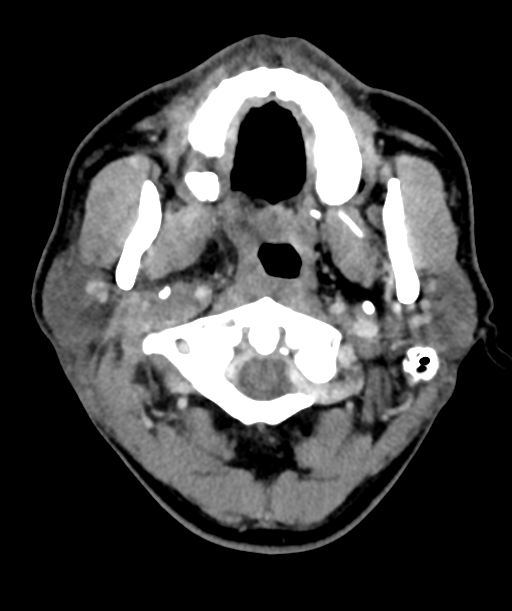 Cervical abscess (Radiopaedia 43725-47184 A 15).png