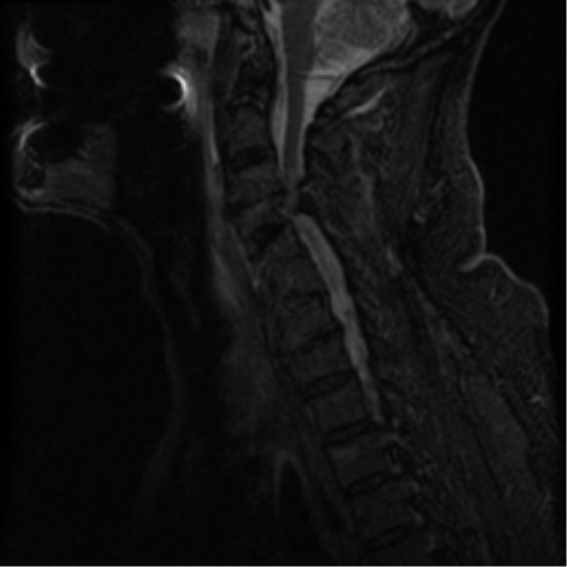 File:Cervical canal stenosis with cord compression (Radiopaedia 34114-35374 Sagittal STIR 9).png