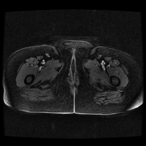 File:Cervical carcinoma (Radiopaedia 70924-81132 Axial T1 C+ fat sat 13).jpg