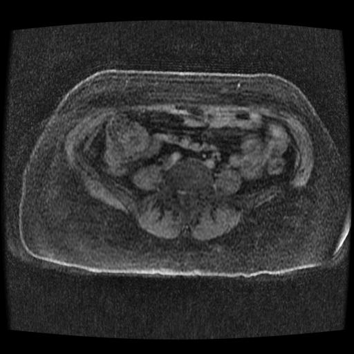 Cervical carcinoma (Radiopaedia 70924-81132 Axial T1 C+ fat sat 263).jpg
