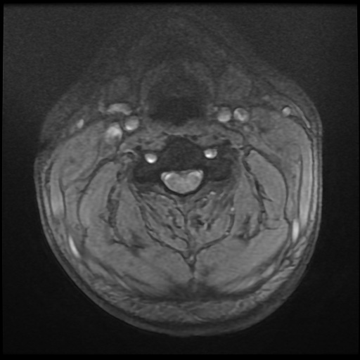 Cervical disc extrusion (Radiopaedia 59074-66364 F 12).jpg