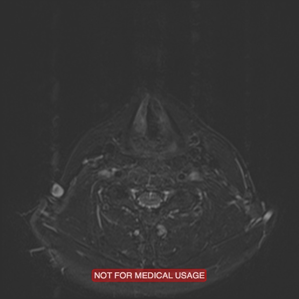 File:Cervical nerve schwannoma (Radiopaedia 27964-28221 C 38).jpg