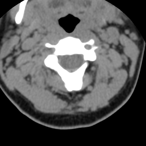 Cervical schwannoma (Radiopaedia 57979-64974 Axial non-contrast 24).png
