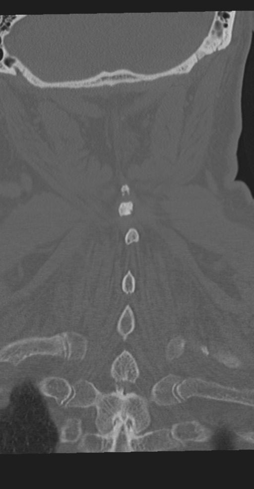Cervical spine fracture in the setting of ankylosis (Radiopaedia 37038-38715 Coronal bone window 58).png