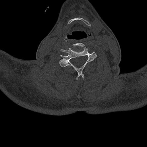 Cervical spine trauma with tear drop fracture and perched facet joint (Radiopaedia 53989-60127 Axial bone window 103).jpg