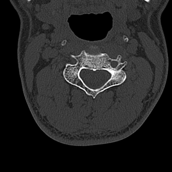 Cervical spondylodiscitis (Radiopaedia 28057-29489 Axial bone window 33).jpg