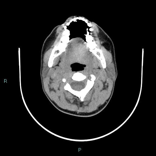 File:Cervical thymic cyst (Radiopaedia 88632-105335 Axial non-contrast 84).jpg